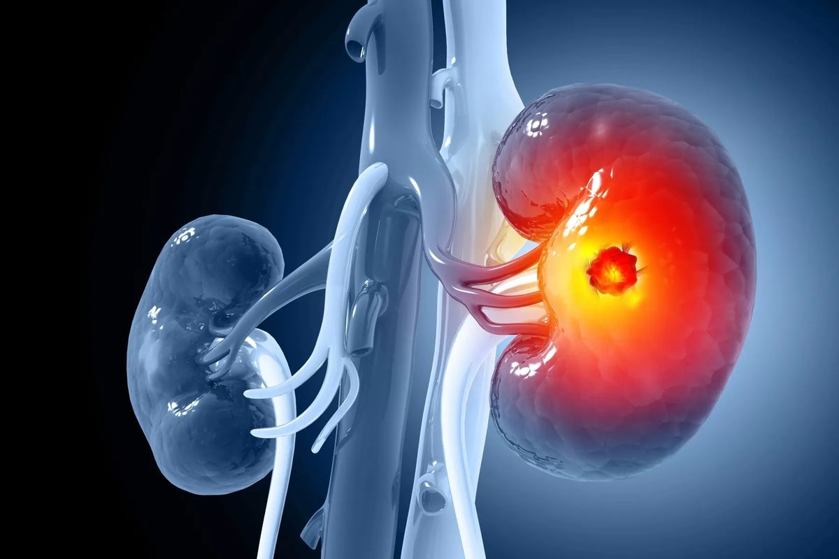 Urinary Tract Cancer Treatment in Gurgaon