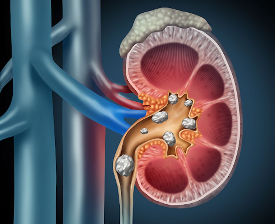 Advanced Kidney Stone Treatment in Gurgaon