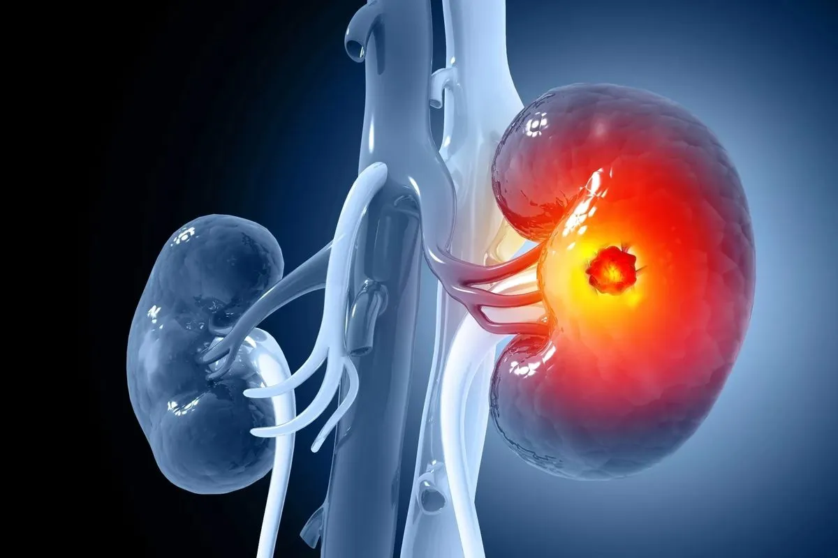 Kidney Cancer Treatment in Gurgaon