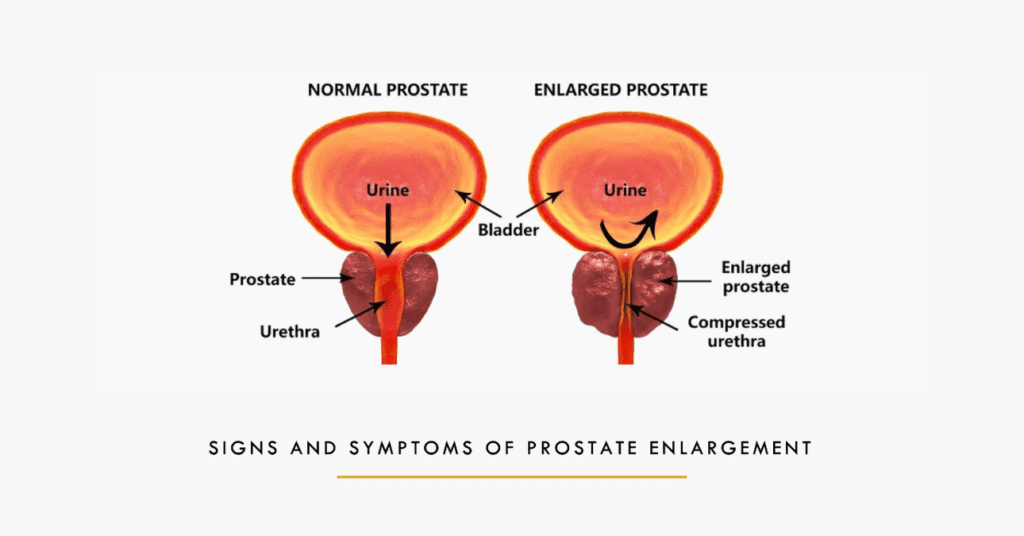 prostate enlargement