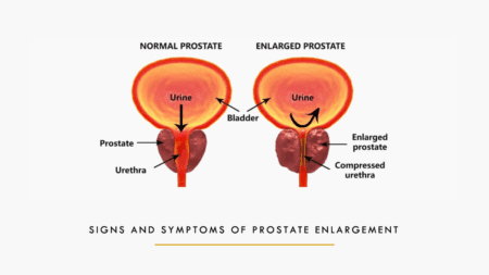 prostate enlargement