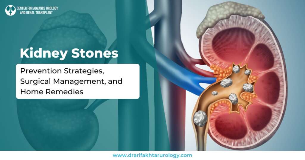 Kidney Stones Prevention Strategies, Surgical Management, and Home Remedies
