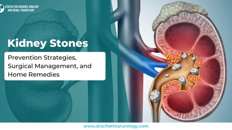 Kidney Stones Prevention Strategies, Surgical Management, and Home Remedies