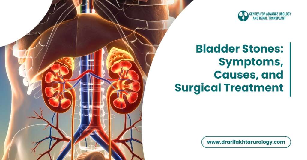 Bladder Stones Symptoms, Causes, and Surgical Treatment