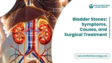 Bladder Stones Symptoms, Causes, and Surgical Treatment