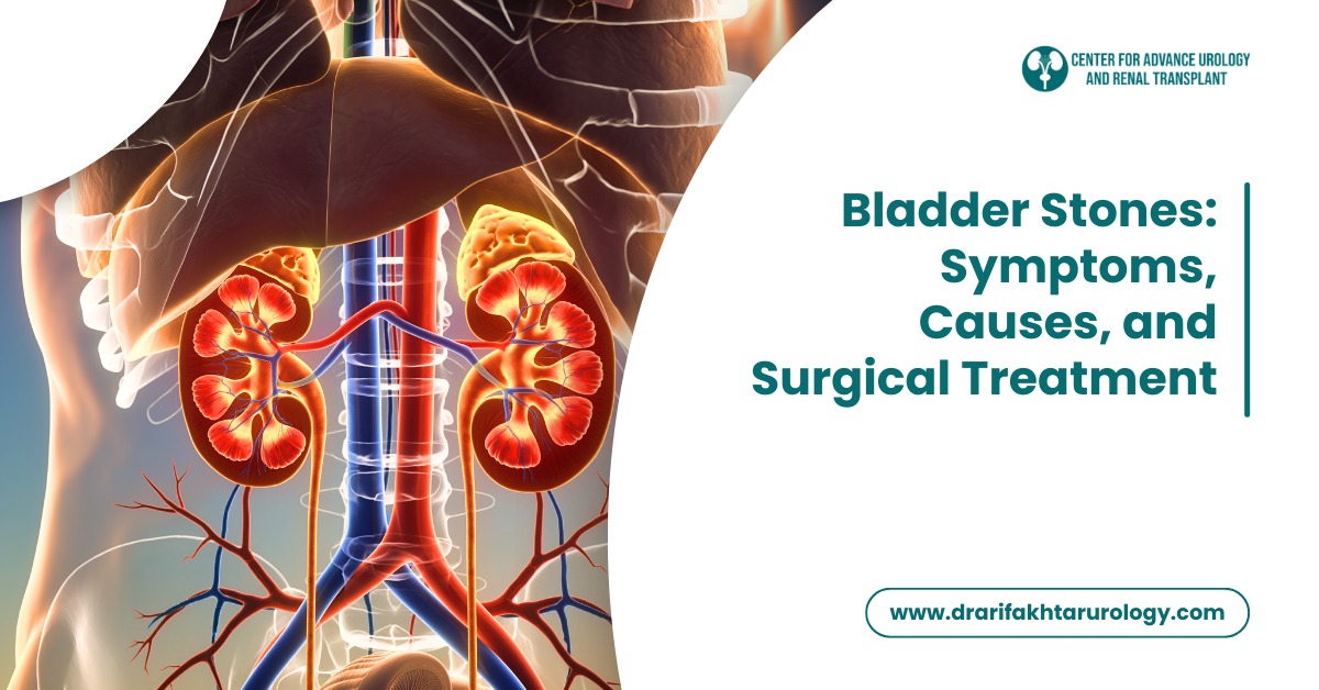Bladder Stones Symptoms, Causes, and Surgical Treatment