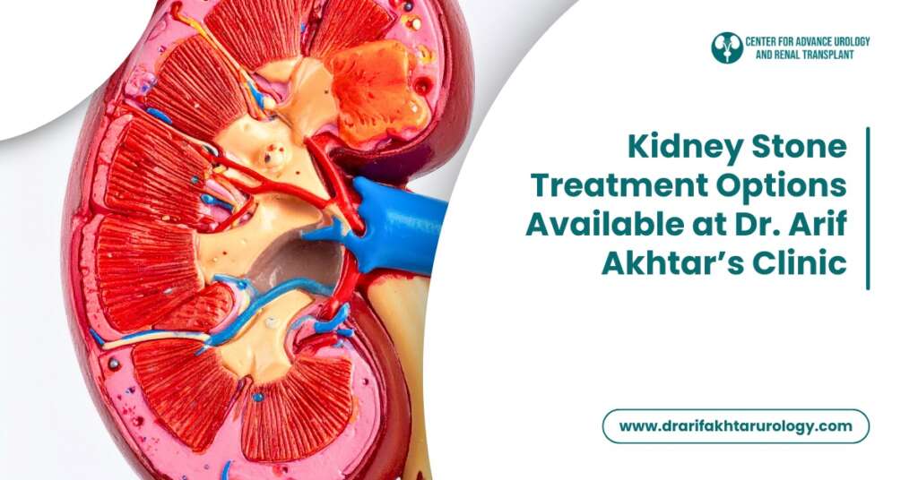 Kidney Stone Treatment Options Available at Dr. Arif Akhtar’s Clinic