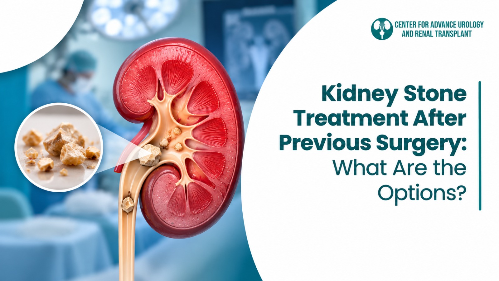 Kidney stone treatment options after previous surgery including RIRS Mini-PCNL and ECIRS